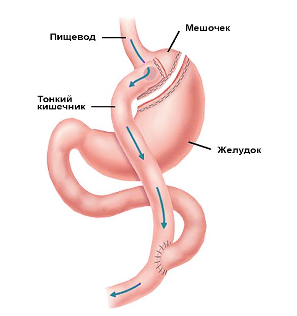 Gastrit-baypass-_1_1.jpg