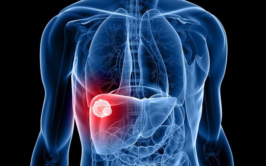late-stage-liver-cancer-nanoparticle-treatment-1