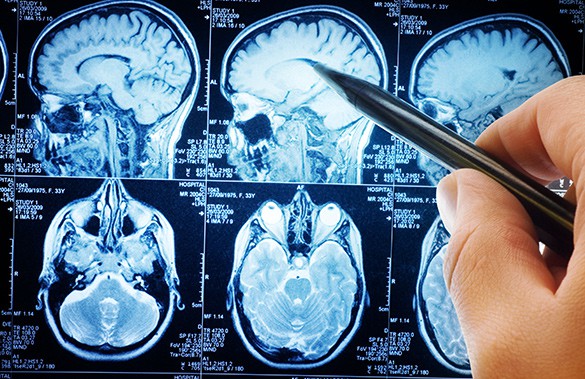 Методы диагностики опухолей головного мозга (лучевые, анализы) |  Диагностика рака головного мозга в Турции