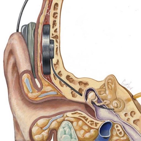 кохлеарная имплантация 5