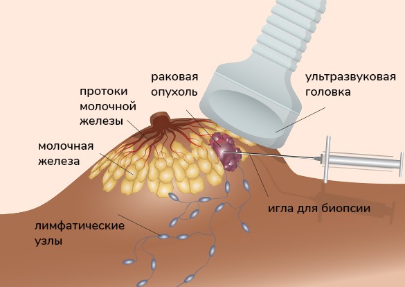 биопсия молочной железы