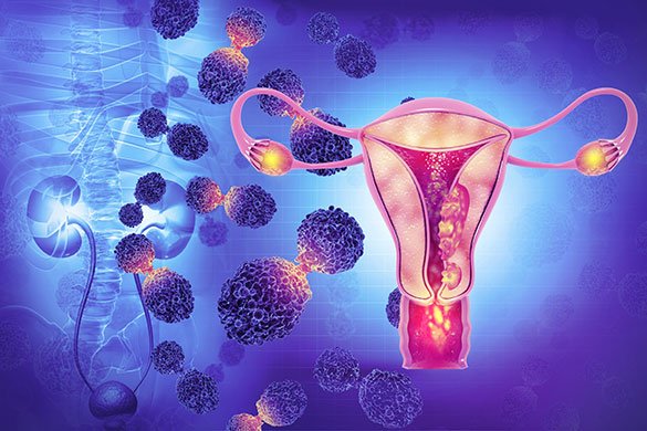 Рак шейки матки: стадии, лечение, прогноз — лечение в ведущей клинике Турции